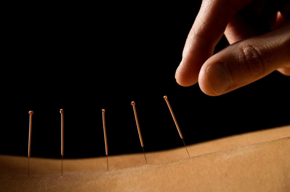 Acupuncture - Naturopathy Therapy - World of Naturopathy Ayurvedic Centres Naturopathy Therapy